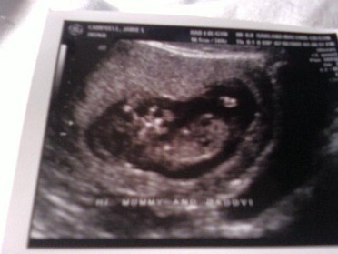 20090710a Campbell Newborn Lily First Picture Of Baby Campbell Aka Lil Spence